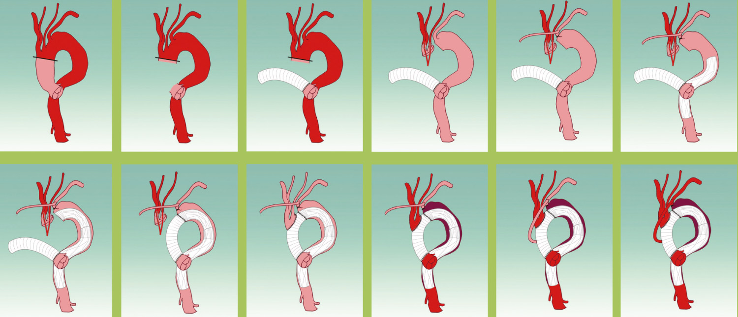 Intraluminales Stenting