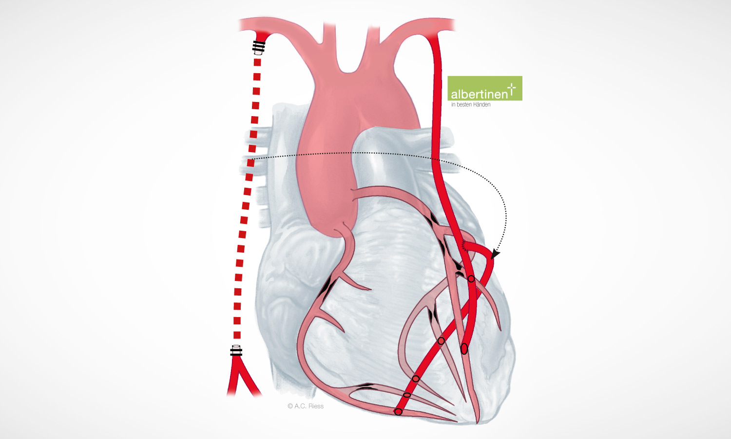 Schematische Darstellung der komplett arteriellen Revaskularisation